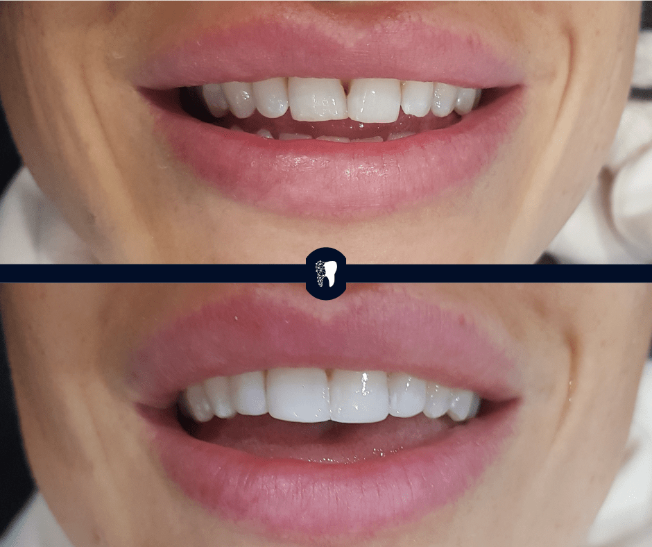 Before and after — smile transformation case 4